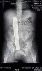 X-Ray